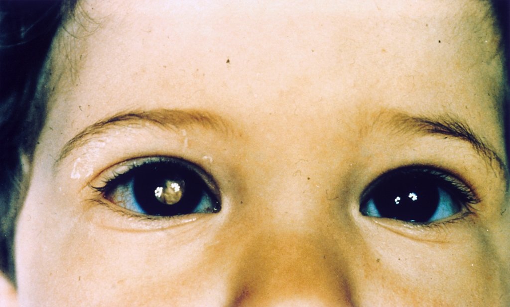  Un copilaş fără un ochi din cauza cancerului şi frăţiorii lui flămânzi au casa inundată