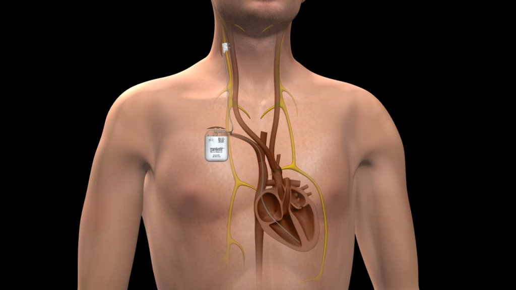  Stimulator cardiac: pot avea o viaţă normală după implantare?