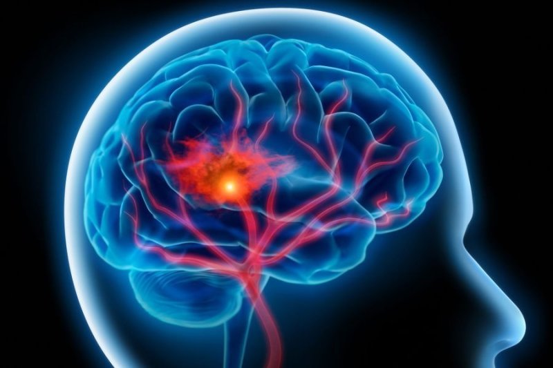  Cum arata creierul unei persoane cu mai multe kilograme in plus. Dezvaluirea alarmanta a oamenilor de stiinta