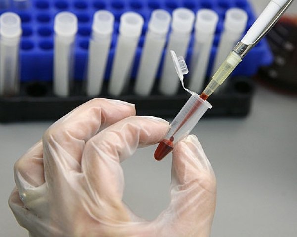  Un nou test sangvin poate să detecteze cancerul oral cauzat de boli cu transmitere sexuală