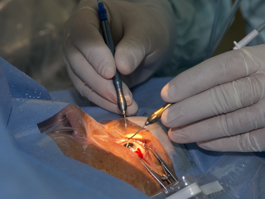  Două transplanturi de cornee la Iaşi, de la un donator în moarte cerebrală