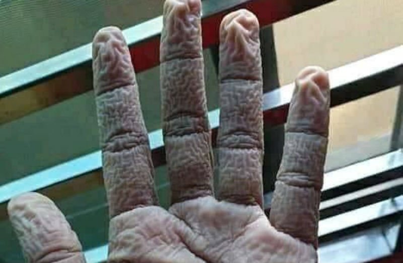  Așa arată mâinile personalului medical după ore întregi de purtat mănuși