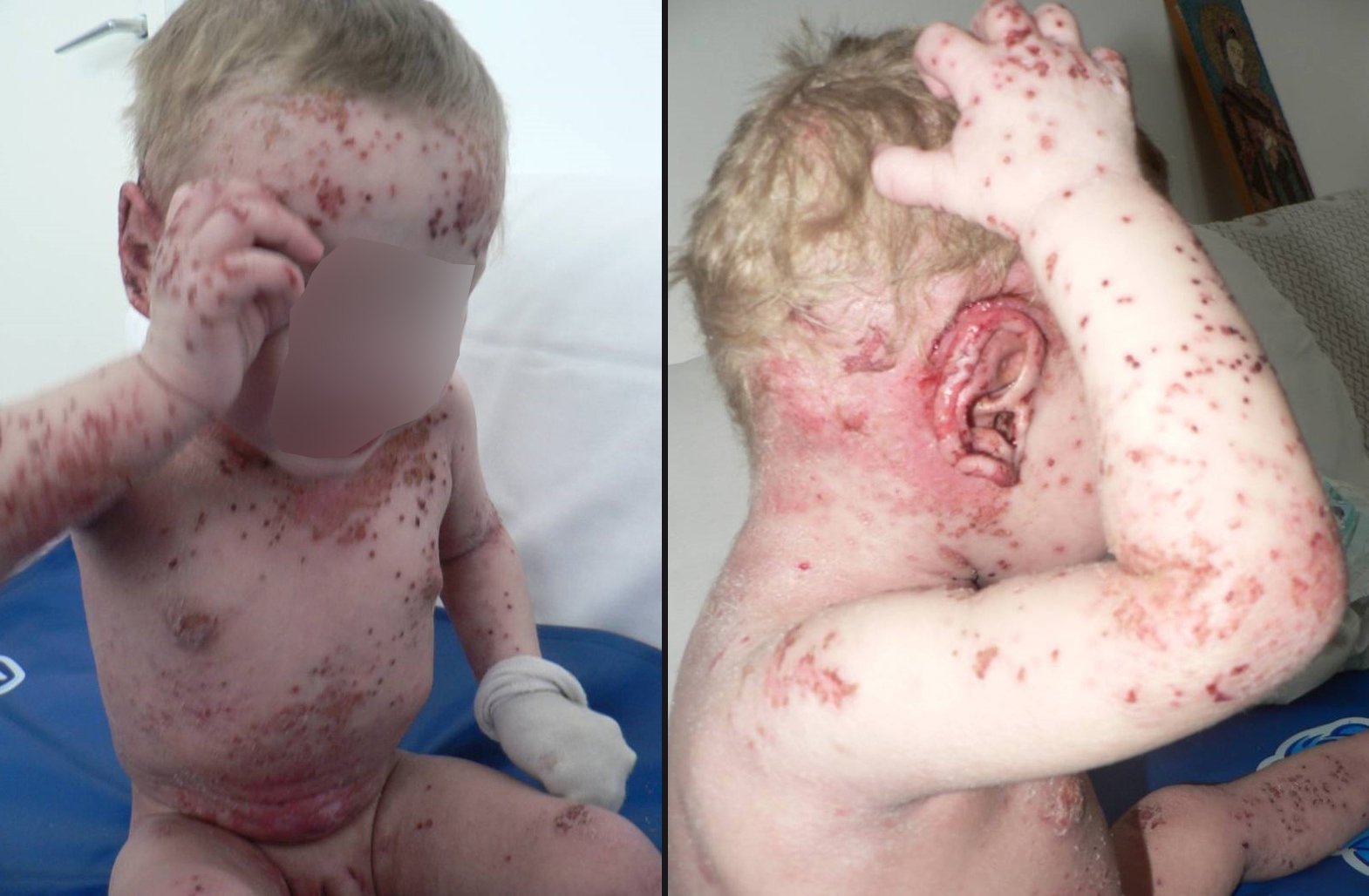  Dermatita atopică – boala care unește în suferință medici și părinți pentru copiii care se scarpină până la sânge