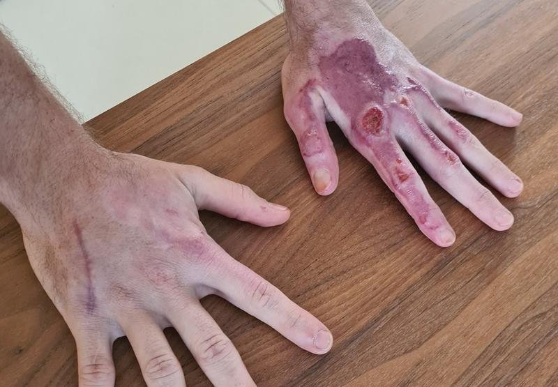 Cum arată mâinile pilotului Romain Grosjean la circa două luni de la accident
