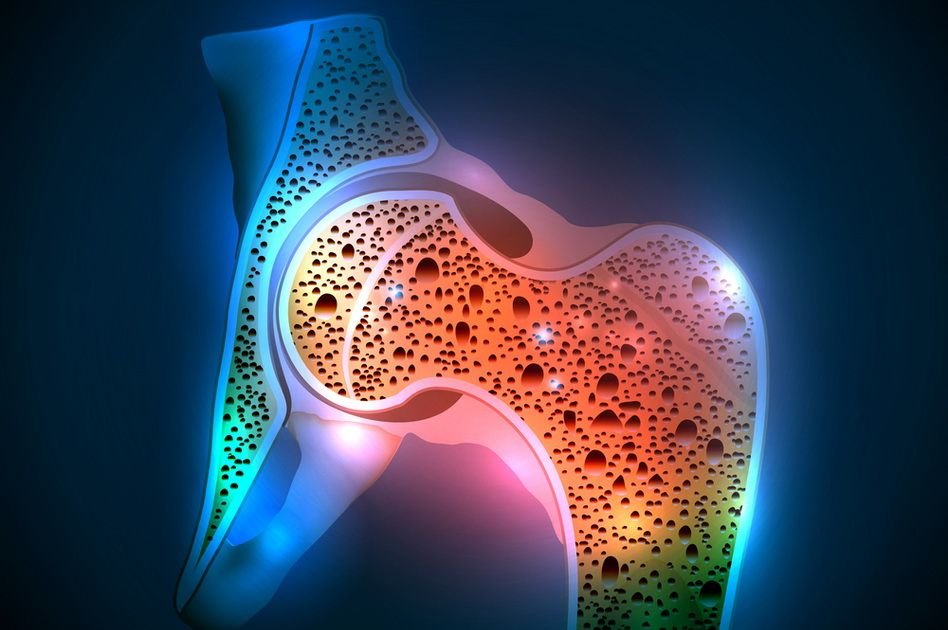  O nouă formă de medicament poate ajuta la tratarea osteoporozei