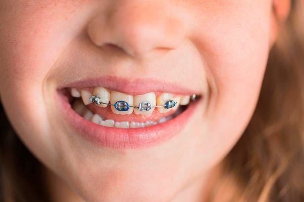  8 din 10 copii români au nevoie de aparat dentar. Mulți ajung târziu la medic
