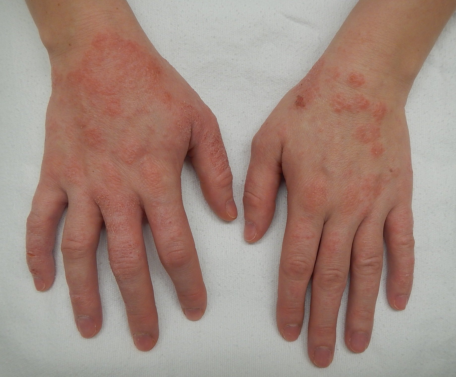  Mai multe boli de piele din cauza stresului provocat de pandemie. Câteva semne importante