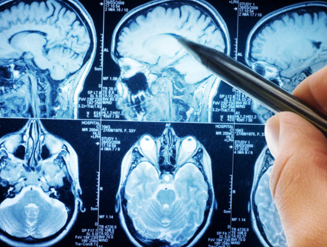  Durerile de cap care nu trec cu calmante pot semnala o tumoare pe creier. Detalii cu medicul neurochirurg,  Marius Dabija