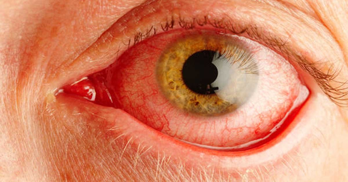  Sindromul ochiului uscat poate fi ameliorat cu lacrimi artificiale