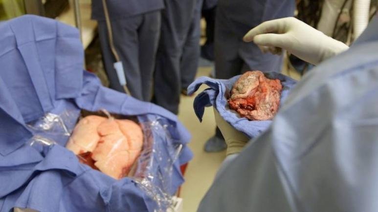  Medicii pot face din nou transplant pulmonar la Spitalul Sfânta Maria din Capitală