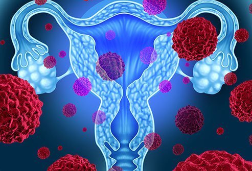  Depistate în fază incipientă, 98% dintre femeile cu cancer de col uterin pot fi salvate