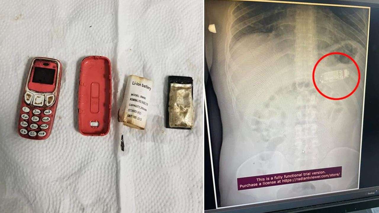  Un medic a scos un telefon marca Nokia 3310 din stomacul unui deţinut