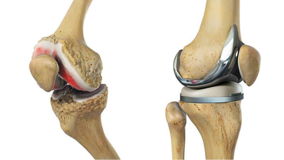  Gonartroza apare prin degradarea cartilajului articular de la nivelul genunchiului