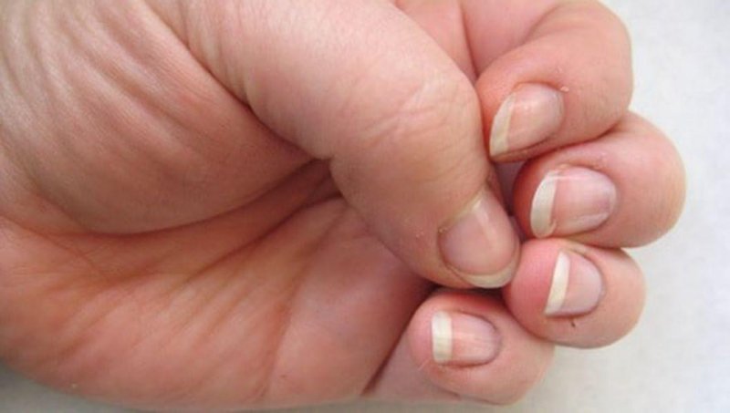  Aspectul unghiilor poate anunţa un cancer de piele