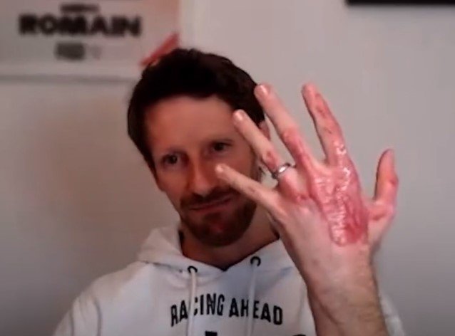  Cum arată mâna lui Romain Grosjean la un an după terifiantul accident suferit la Sakhir