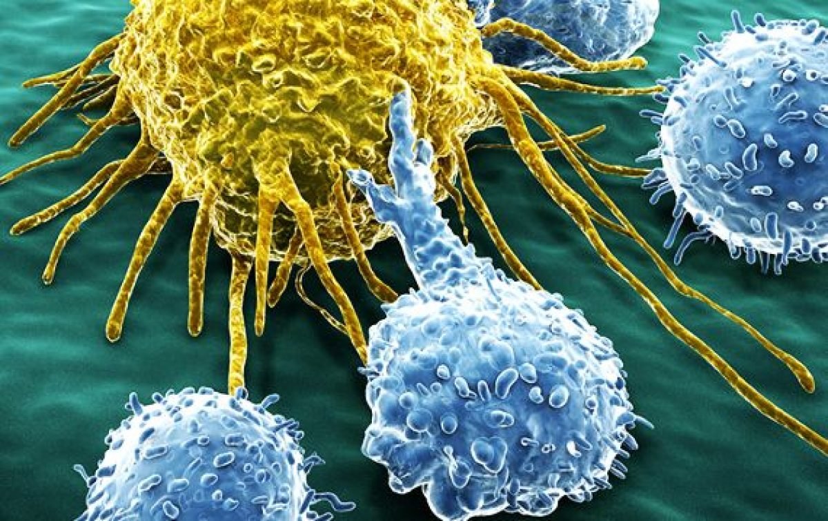  Terapie cu celule NK în tratarea cancerului