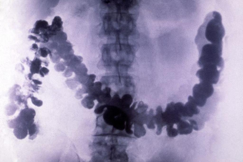  Șapte persoane și-au făcut radiografie gastrică cu sulfat de bariu și au murit. Medicii au folosit substanțe industriale
