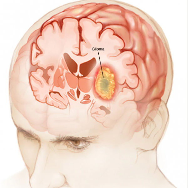  Glioblastomul – o tumoră cerebrală malignă extrem de severă. Sfaturile unui cunoscut medic iesean