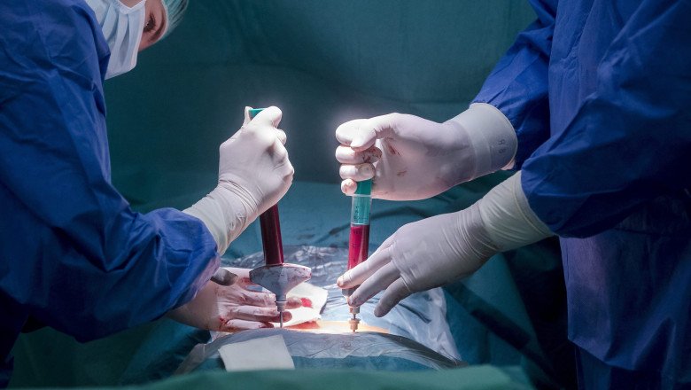 Două transplanturi la Iaşi cu rinichi aduşi de la Oradea