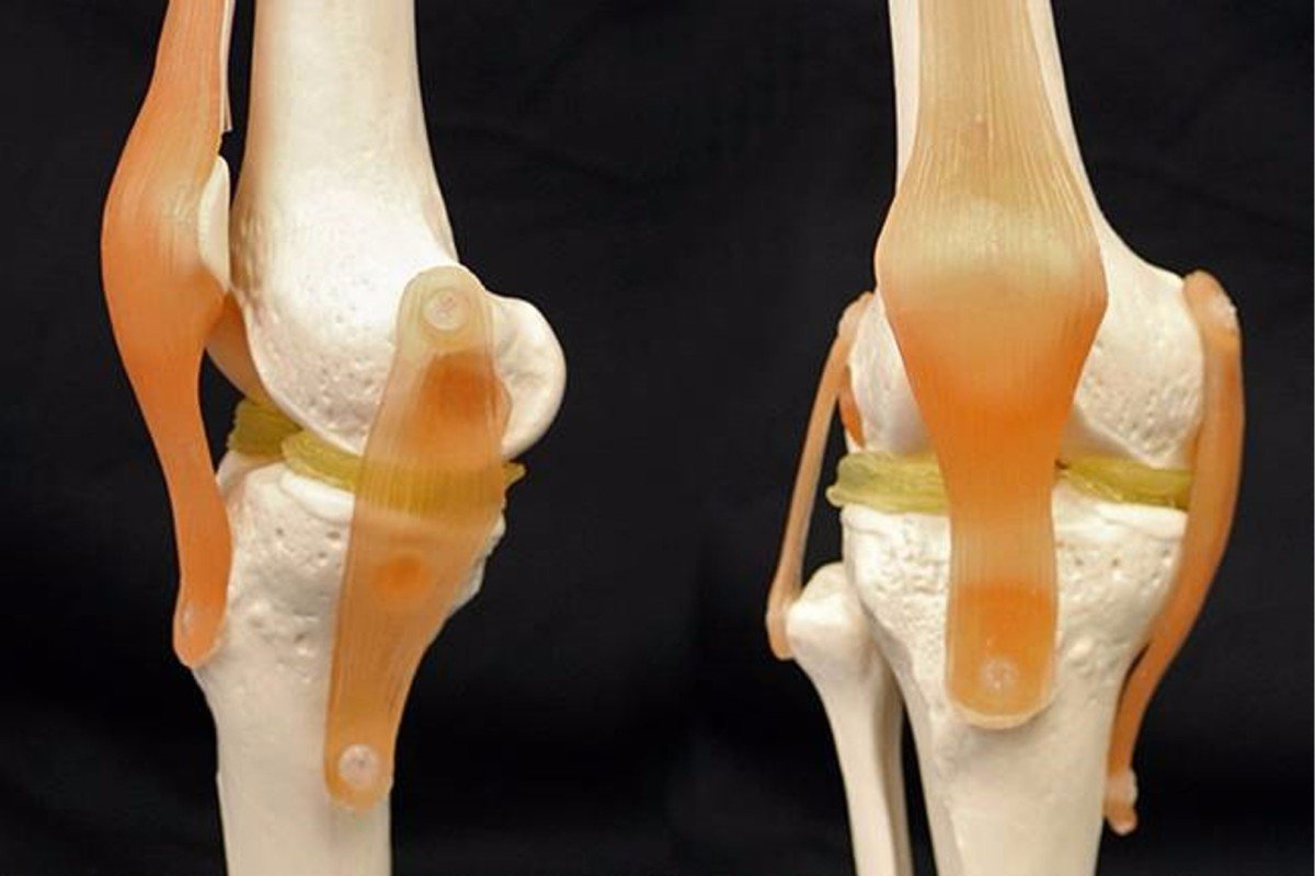  Implant personalizat de genunchi imprimat 3D, pentru bolnavii de artrită