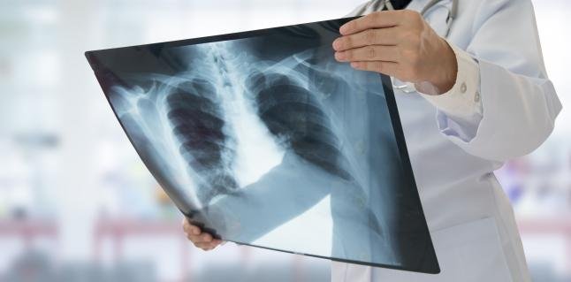  Un aparent paradox medical, în pandemie: cum au scăzut la Iaşi cu 40% cazurile de TBC?
