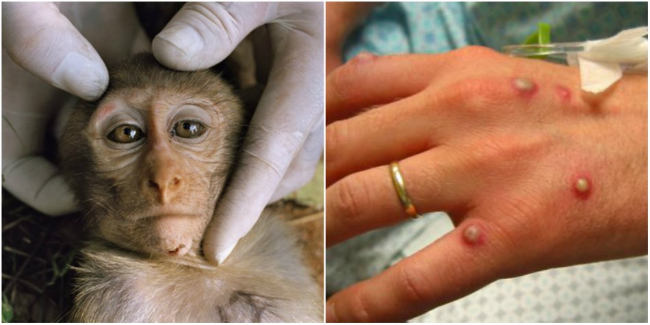  Şeful de la Infecţioase Iaşi: Momentan nu există niciun caz de variolă a maimuţei