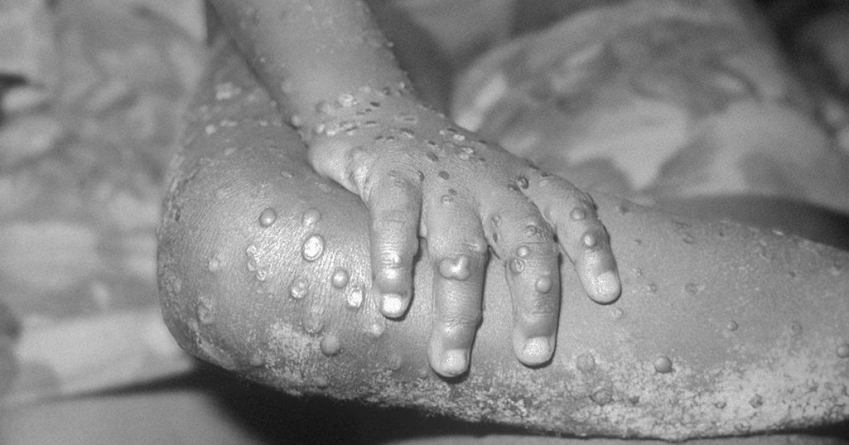  Alertă în Canada. Quebec confirmă 15 cazuri de variola maimuţei