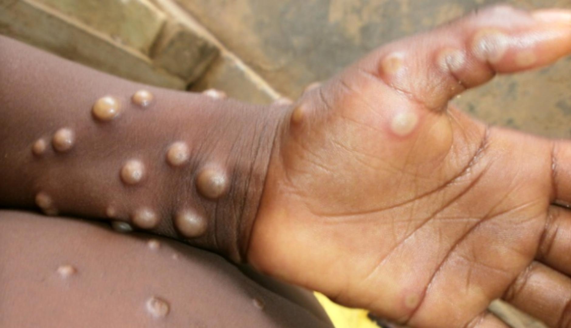  OMS se teme că variola maimuţei se instalează în ţări non-endemice