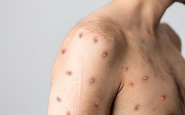  Primul caz de variola maimuţei diagnosticat în România – Un bărbat de 26 de ani din Bucureşti