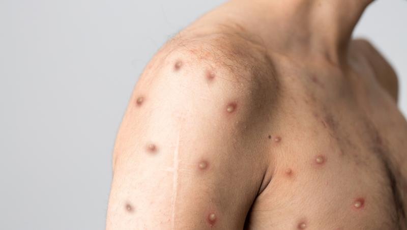  Un nou caz de variola maimuţei în Românie. Este vorba despre un bărbat de 36 de ani