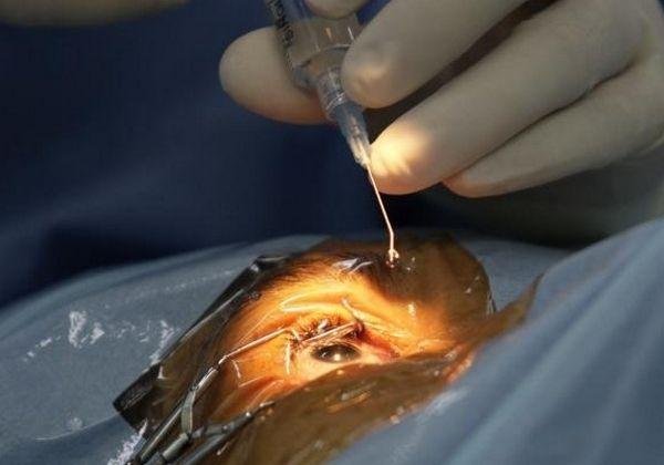  Un bărbat a rămas fără vedere după ce a fost operat la ochiul greșit