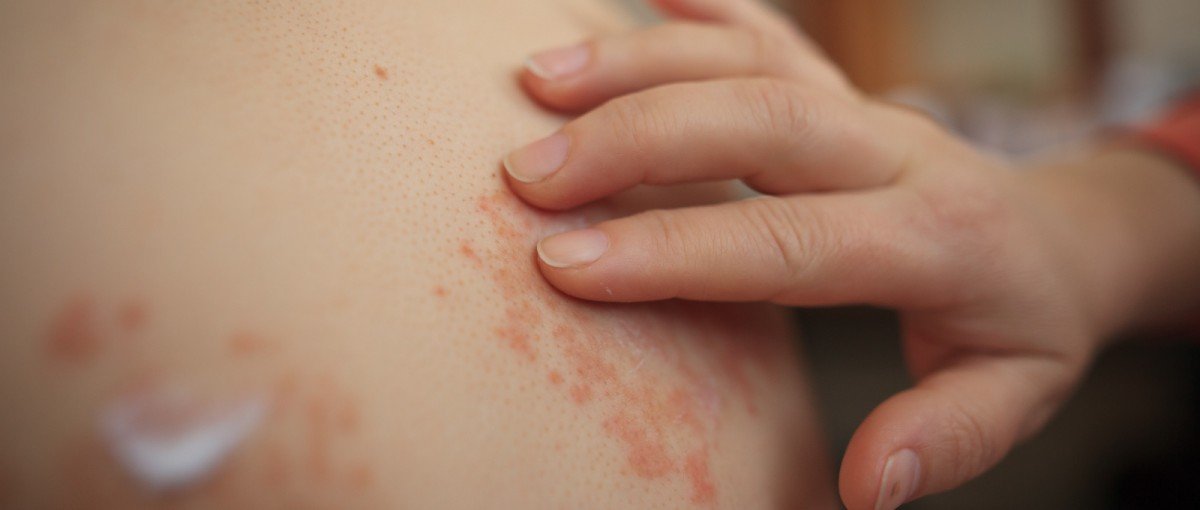  Copil de 9 ani cu o boală cumplită, declanşată de un medicament: 70% din piele este ca arsă