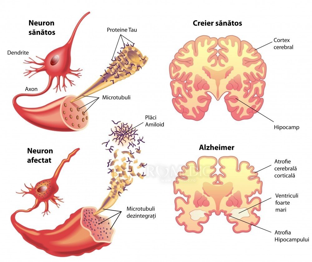  Boala Alzheimer ar putea fi oprită într-un stadiu fără simptome