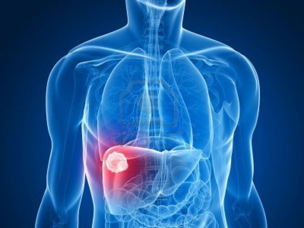  Numărul cancerelor hepatice ar urma să crească cu 55% până în 2040 (studiu)