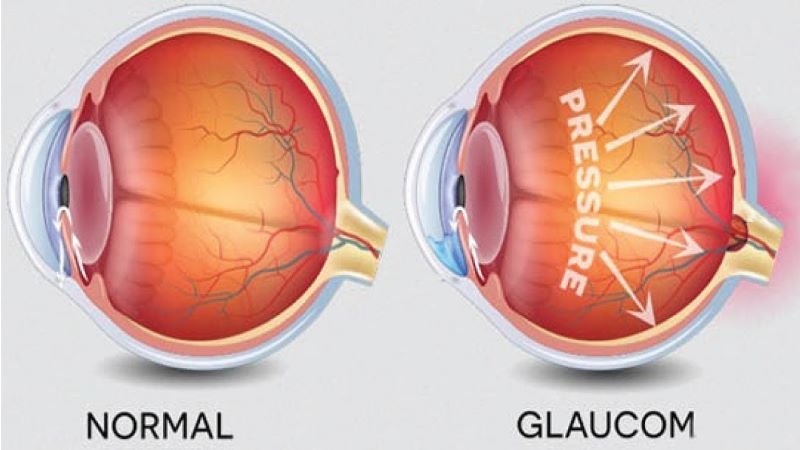  Stresul accelerează apariția glaucomului