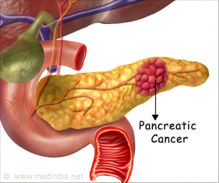  Un implant radioactiv ar putea elimina definitiv tumorile cancerului pancreatic