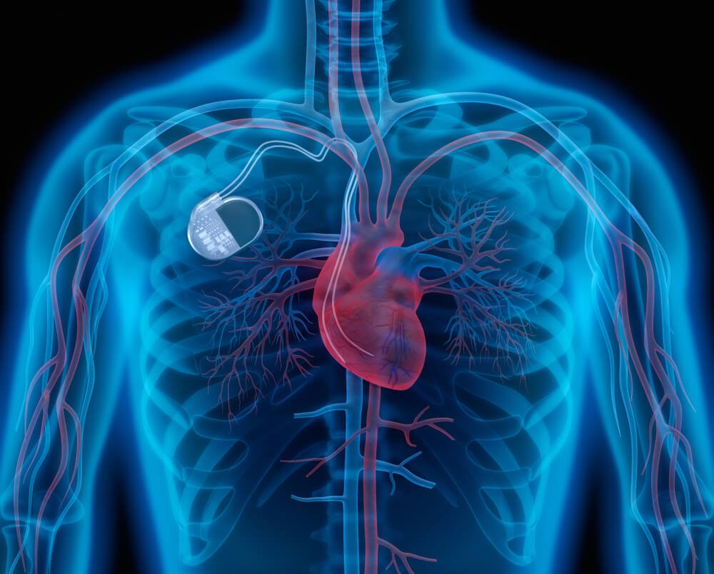  Cardiologii români care au implantat unor pacienți stimulatoare cardiace luate de la cadavre s-au inspirat dintr-un caz identic din Germania petrecut în 1976