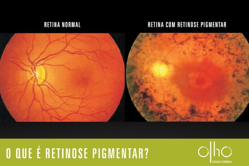  Persoanele cu retinită pigmentară și-ar putea recăpăta vederea
