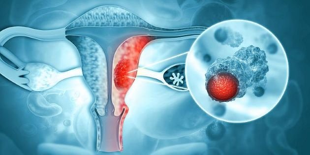  Un nou potențial tratament pentru cancerul ovarian
