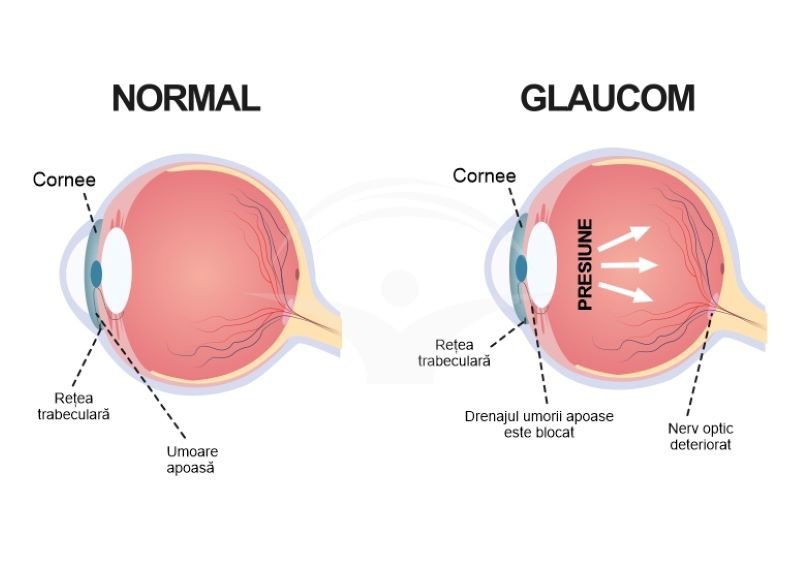  Abordare genetică pentru tratarea glaucomului