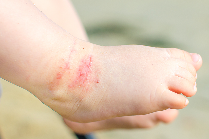 Cât îi costă pe pacienţi viaţa afectată de dermatita atopică? Un studiu inedit