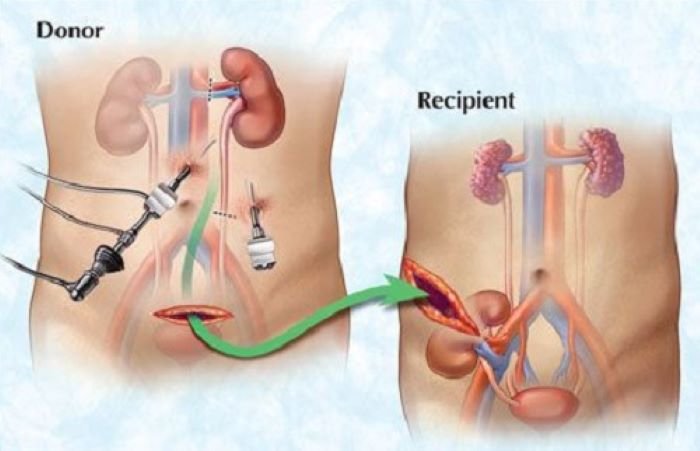  Tratament nou pentru a tolera mai ușor rinichii transplantați