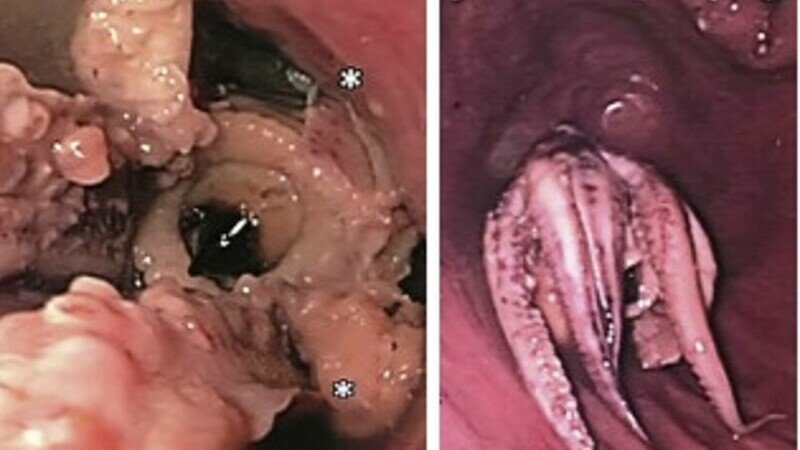  Descoperirea șocantă: Ce au găsit medicii în  esofagul unui pacient. Care sunt simptomele
