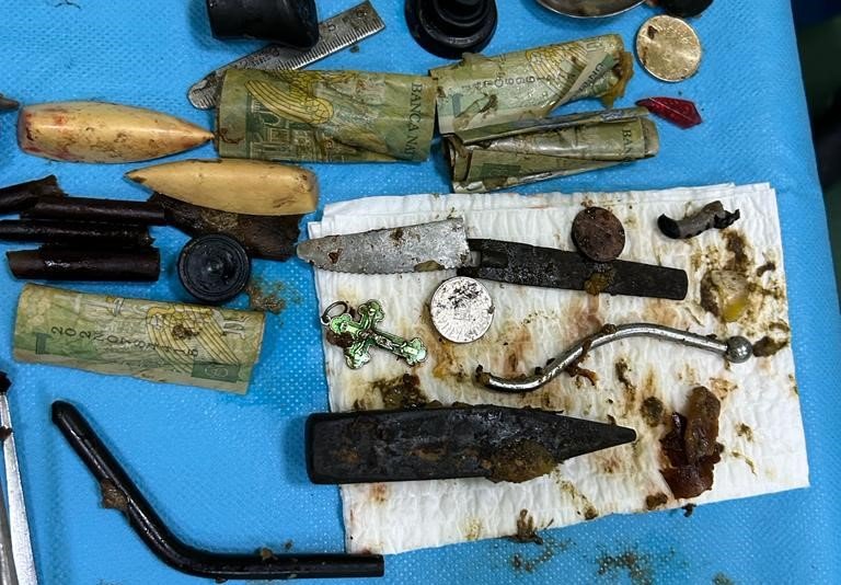  Stomacul unui bărbat operat de medicii ieșeni conținea: bani, lamă de cuțit, piroane, un ciocan, obiecte de metal, de cauciuc, de plastic