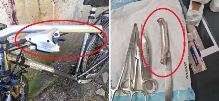  Un medic a uitat în piciorul unui pacient mânerul de frâna de la bicicletă, în timpul unei operații. L-a cusut si l-a trimis acasă