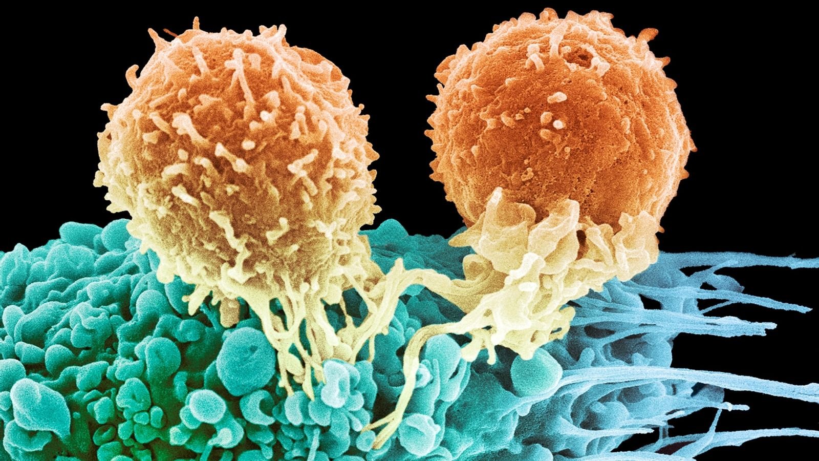  O nouă ţintă terapeutică pentru cancerul metastatic, identificată de cercetători