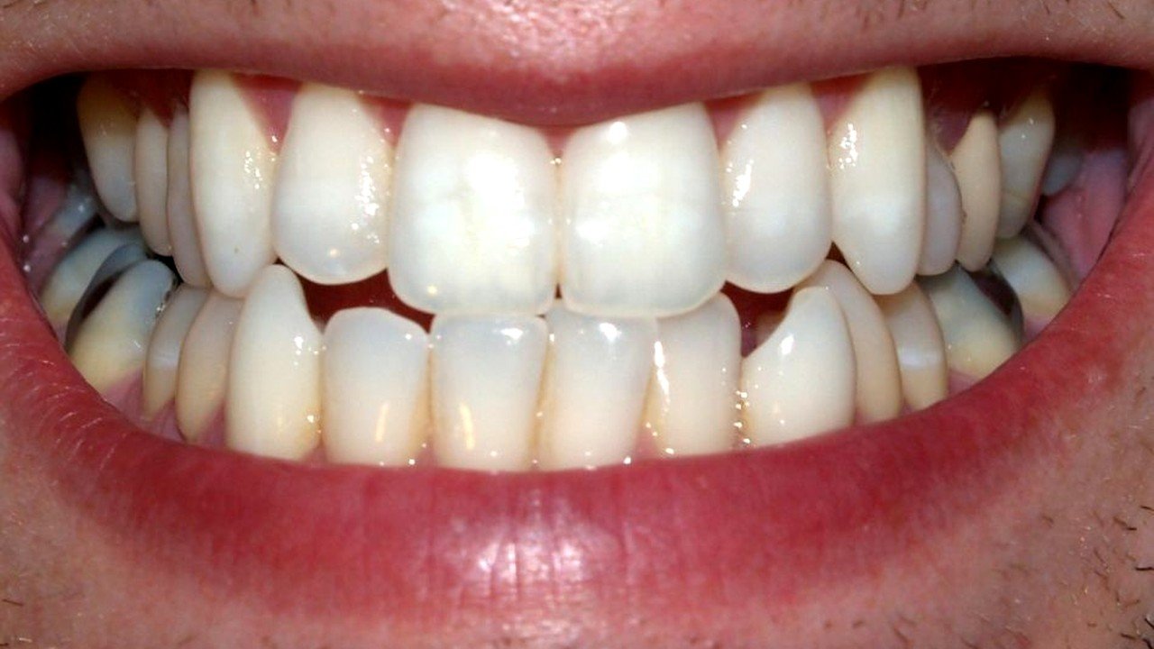  Descoperire revoluționară în stomatologie: Medicamenul care va duce la creșterea dinților