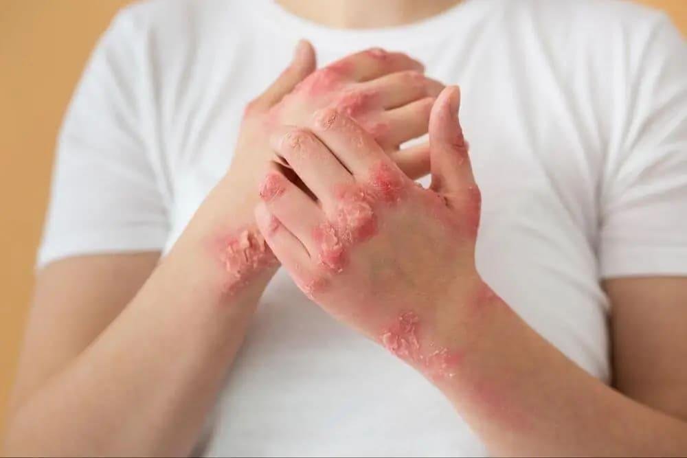 Medic: Psoriazis, o afecţiune cronică a pielii care nu se vindecă niciodată, dar poate fi ţinută sub control