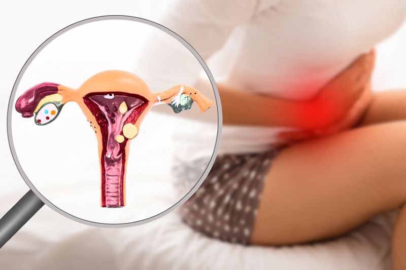  Endometrioza și sindromul intestinului iritabil au factori de risc genetic comuni?