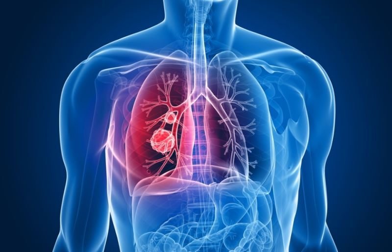  A fost descoperită cheia implicată în răspândirea cancerului pulmonar?